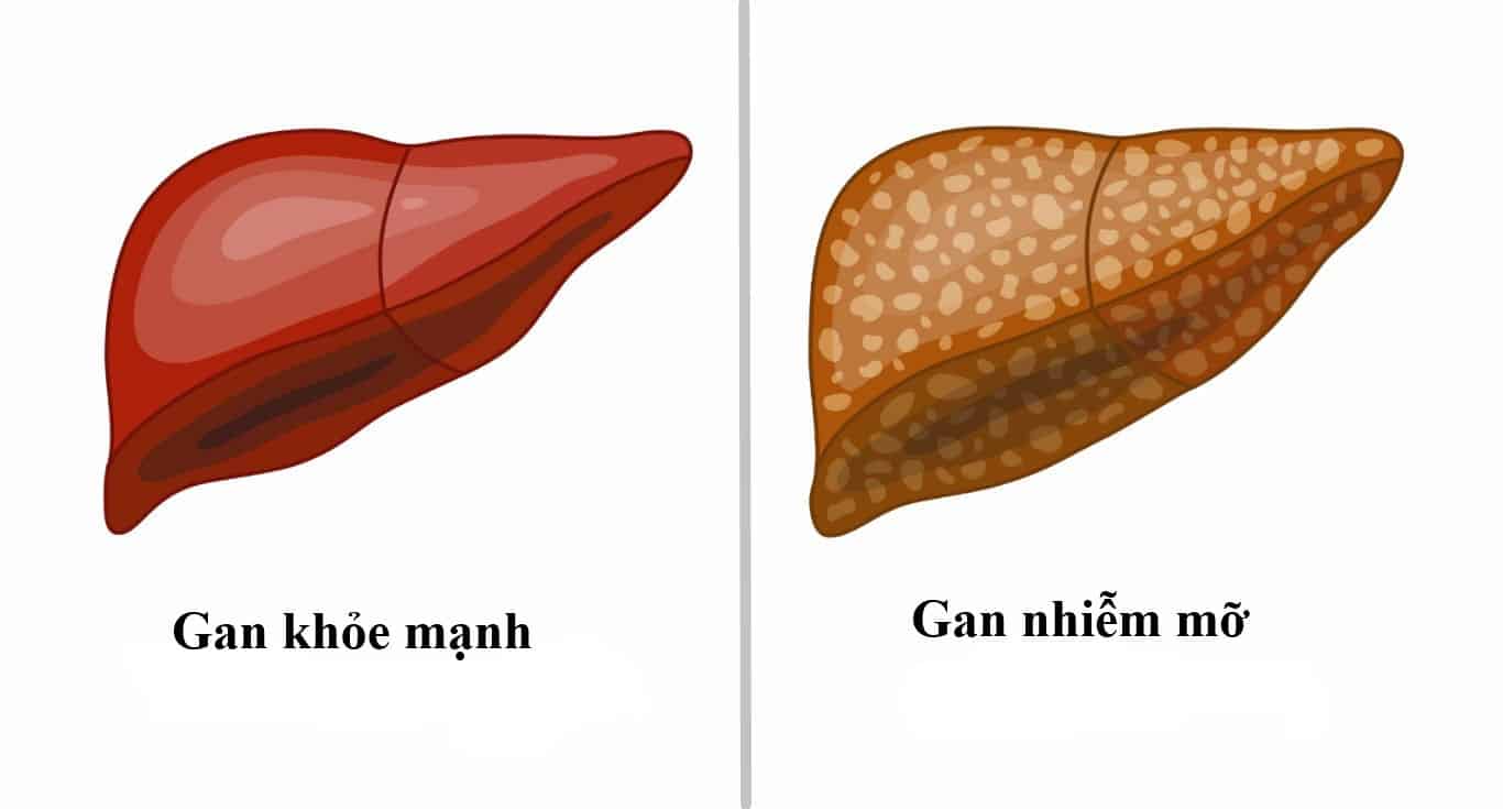 Không uống rượu bia, vì sao vẫn bị gan nhiễm mỡ?